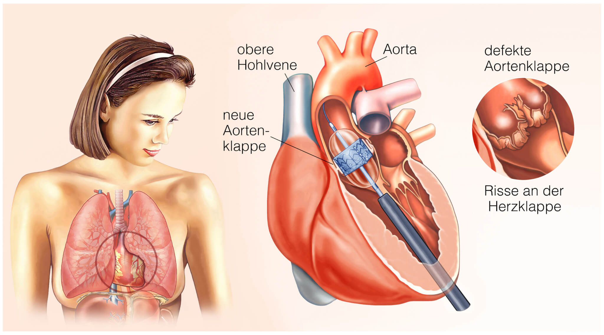 TAVI bei immer mehr Patientengruppen empfohlen - Biermann Medizin
