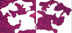 Schnitt durch Brustkrebsgewebe: Wenn Immunzellen (kleine dunkle Zellen) in den Tumor einwandern, haben Brustkrebspatientinnen gute Chancen, dass die Chemotherapie anschlägt. Das linke Bild zeigt hauptsächlich Tumorzellen (runde violette Zellen). Auf der rechten Seite sieht man, wie körpereigene Abwehrzellen (tumor-infiltrierende Lymphozyten, TILs) den Tumor infiltrieren. Quelle: © S. Wienert, C.Denkert, Charité