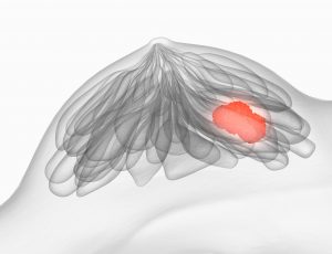 Brustkrebs Mammographie llustration. Foto: © Axel Kock - Fotolia.com