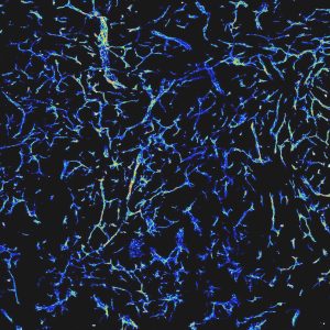 Mikroskopische Darstellung des dichten Netzes von Blutgefäßen in einem wachsenden Tumor. Quelle: La Porta, DKFZ