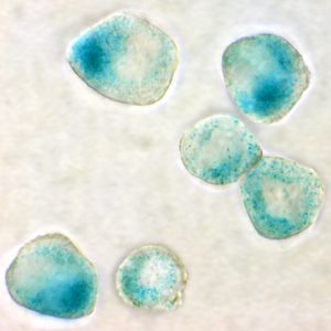 Therapieinduzierte seneszente Lymphomzellen. Foto: AG Schmitt