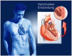 Herzmuskelentzündung.Myokarditis. Foto: © Henrie - Fotolia.com
