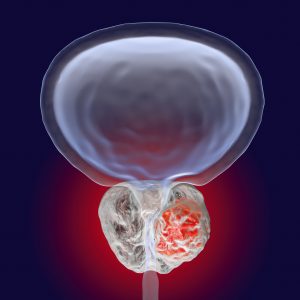 Prostata Krebs, Illustration. Foto: © Kateryna_Kon - Fotolia.com