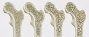 Osteoporose