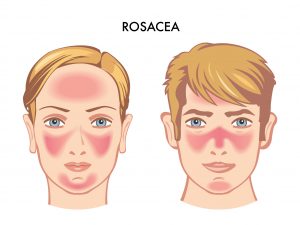 Rosacea