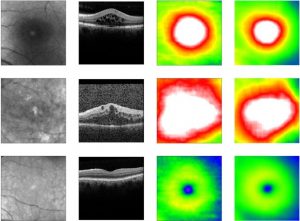 Algorithmus sagt die Netzhautdicke voraus. Von links nach rechts: Fundus-Bild, OCT-Bild, tatsächliche Netzhautdicke, vorhergesagte Netzhautdicke. Bild: Helmholtz Zentrum München