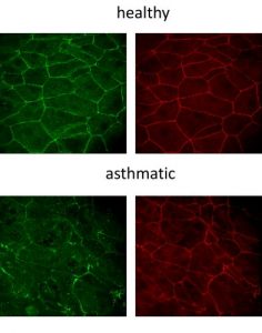 Gerade und klare Epithelbarriere von gesunden Bronchialepithelzellen (oben) und undichte und beschädigte asthmatische Epithelzellen (unten). Bild: Cezmi Akdis