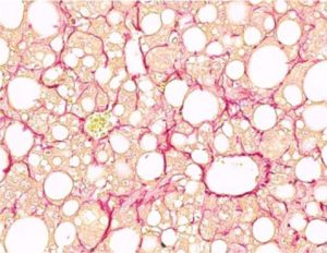 Lebergewebe mit Fibrose und rot markierten Kollagenfasern. Foto: Helmholtz Zentrum München / Anne Loft