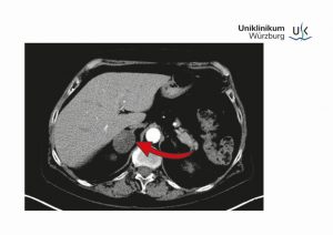 Das MRT zeigt einen drei Zentimeter großen Nebennierentumor auf der rechten Seite. 80 bis 90 Prozent dieser Tumore, die meist zufällig entdeckt werden, sind gutartig. Foto: UKW