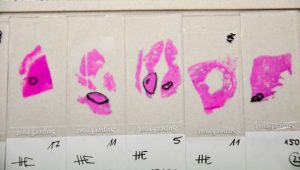 Glasobjektträger mit Prostata-Gewebeproben. Foto: © Dr. Senckenbergisches Institut für Pathologie des Universitätsklinikums Frankfurt am Main