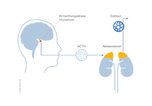 Das Cushing-Syndrom wird in den meisten Fällen durch gutartige Tumore der Hypophyse ausgelöst. Durch den Tumor produziert die Hirnanhangsdrüse ungebremst das Hormon Adrenocorticotropin (ACTH), welches die Nebennieren antreibt, Cortisol auszuschütten. Illustration: Design-Abteilung / UKW