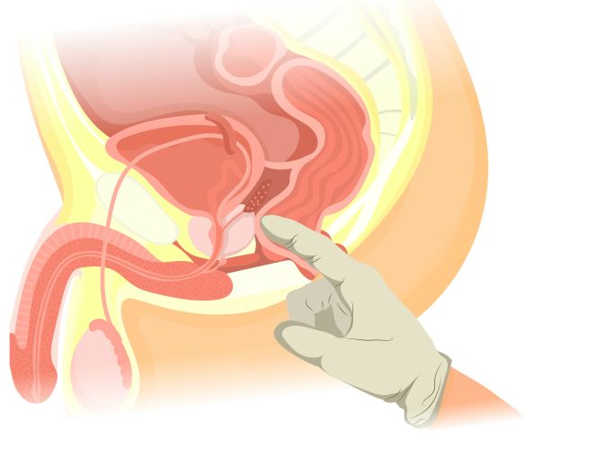 rektale befriedigung Mehr masturbieren gegen Prostatakrebs? Was Studien wirklich sagen main image 0