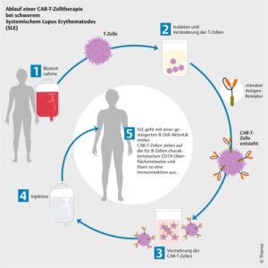 Ablauf einer CAR-T-Zelltherapie bei schwerem Systemischem Lupus Erythematodes (SLE). Bild: DGRh