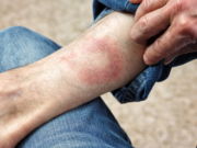 Kutane Lyme-Borreliose: Zeckenstich sechs Wochen im Auge behalten
