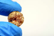 Bei Gallensteinen und Schmerzen im Abdomen ist eine Cholezystektomie nicht immer notwendig