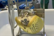 Zwei vollständige Kunstherzen in Heidelberg transplantiert