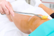 Muss jede Bandruptur am Knie operiert werden?