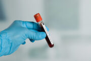 Nierentransplantation: Trockenblutentnahme zur Überwachung immunvermittelter Glomerulopathien bei Kindern sicher