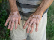Vitiligo: Enzymblockade könnte Erholung der Melanozyten ermöglichen