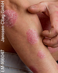the man on the arm and abdomen psoriasis