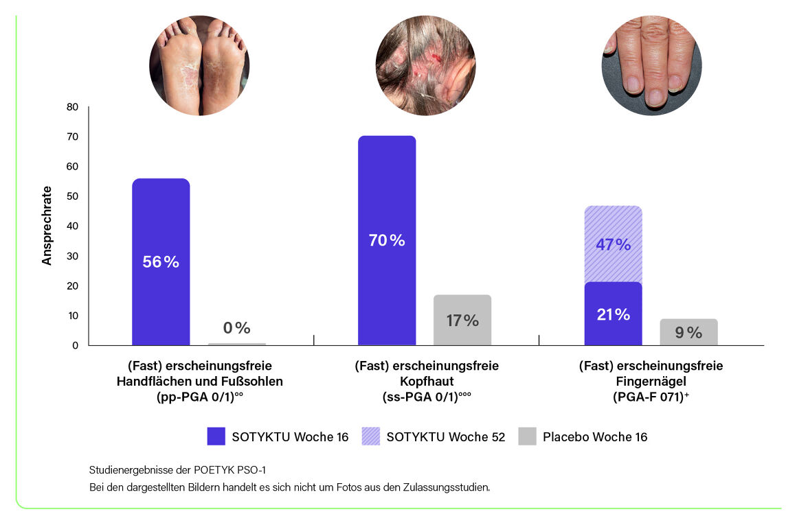 SOTYKTU® – zuverlässig auch bei sensitiven Arealen ***,§§§,°,6
