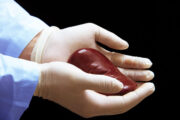 HIV-zu-HIV-Nierentransplantationen laut US-Studie sicher