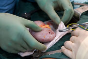 Nierentransplantation: Mikrovaskuläre Entzündungen können Anzeichen für erhöhtes Abstoßungsrisiko sein