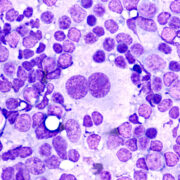 Biologische Klassifikation des Hodgkin-Lymphoms: Sequenzierung zirkulierender Tumor-DNA ergibt drei Subtypen