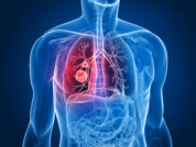 COPD und Lungenkrebsrisiko: Daten aus der NHANES-Studie belegen Zusammenhang vor allem in Subgruppen