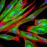 Hautkrebs: Subtypen von Fibroblasten identifiziert