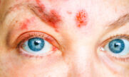 Herpes Zoster ophthalmicus: Langfristiger Einsatz von Virostatika ist der Schlüssel zur Behandlung