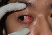 Keratitis: KI könnte Augenversorgung verbessern