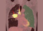 Immuntherapie bei Lungenkrebs: KI-Analyse von PET/CT-Bildern kann Nebenwirkung vorhersagen