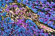 Hepatozelluläres Karzinom: Biomarker kann Ansprechen auf Immuntherapie vorhersagen