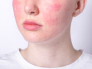 Behandlung entzündlicher Hauterkrankungen mit topischem SYM2081