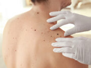 Hautkrebs: Wer profitiert von einer Immuntherapie?