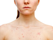 Akne-Rezidive nach Isotretinoin: Frauen häufiger betroffen