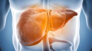 Fettleber ist nicht gleich Fettleber: Risiko für Herzerkrankungen und Diabetes variiert