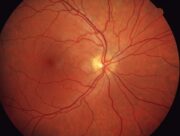 Schlaganfall: Vaskulärer „Fingerabdruck“ der Retina kann Risiko vorhersagen