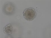 Zungenkrebs: Was Organoide über Chemoresistenz verraten