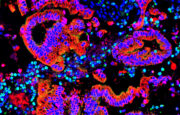 Bauchspeicheldrüsenkrebs: Neue Mechanismen der Beeinflussung durch das Immunsystem entschlüsselt