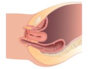 Sicherheit und Wirksamkeit von Vaginalimplantaten in der Prolaps-Chirurgie