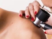 Zielgerichtete Therapie beim Melanom verbessern