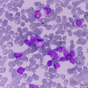 Chronische lymphatische Leukämie: Resistenzmechanismus identifiziert