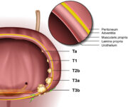 S3-Leitlinie Harnblasenkrebs umfassend aktualisiert