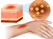 Hautentzündungen können allergisches Asthma verstärken