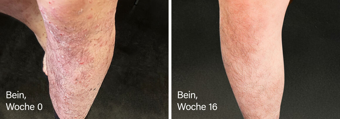 Vorher-nachher Ansicht eines Beines. Auf dem vorher Bild sind viele Plaques zu sehen, auf dem nachher Bild ist das Bein fast erscheinungsfrei.