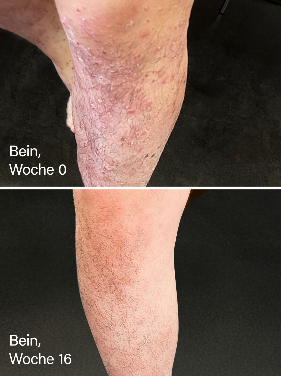 Vorher-nachher Ansicht eines Beines. Auf dem vorher Bild sind viele Plaques zu sehen, auf dem nachher Bild ist das Bein fast erscheinungsfrei.