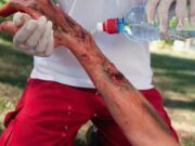 Brandwunden: Neue Generation von Hautersatzstoffen gibt Hoffnung