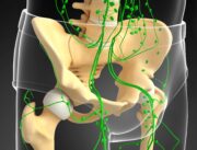 Radikale Prostatektomie: Weniger Metastasen bei erweiterter Beckenlymphknotendissektion